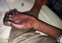 boy lost his hand palm when homeopathy doctor injected in brachial artery